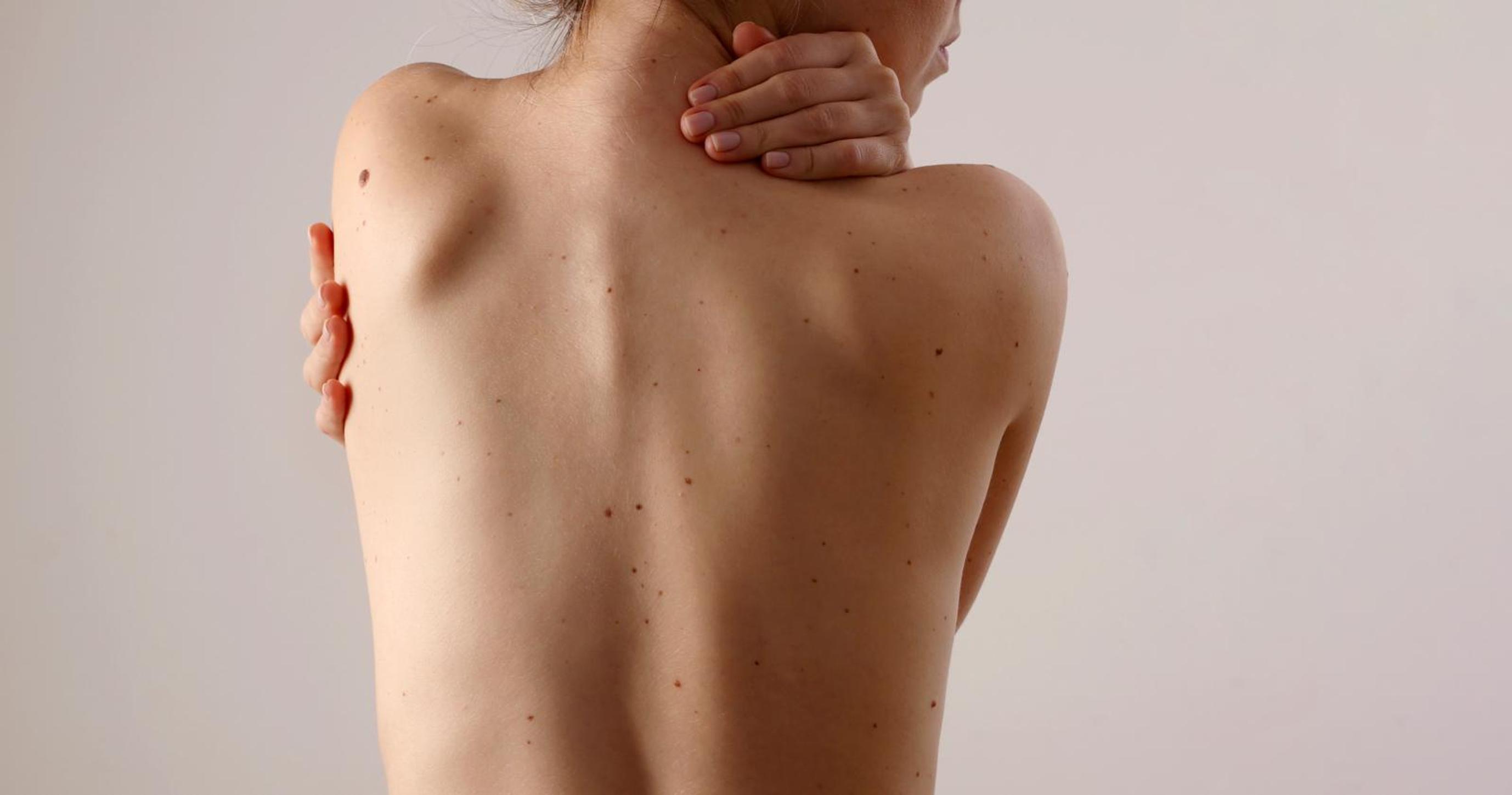 Muista tarkistaa luomesi kerran kuukaudessa – luomihoitaja kertoo, missä sijaitsevat vaarallisimmat luomet