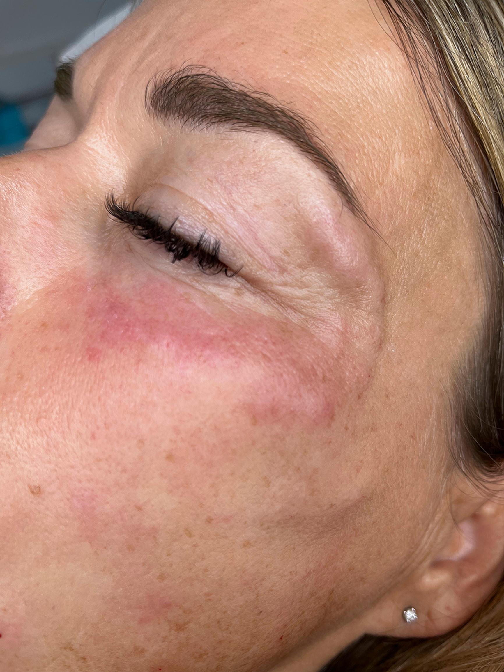 Sunekos-silmänympäryshoidon jälkeen iholle jää pistoksista hetkeksi pieniä vaaleita pampuloita, jotka tasoittuvat jo hoidon aikana.