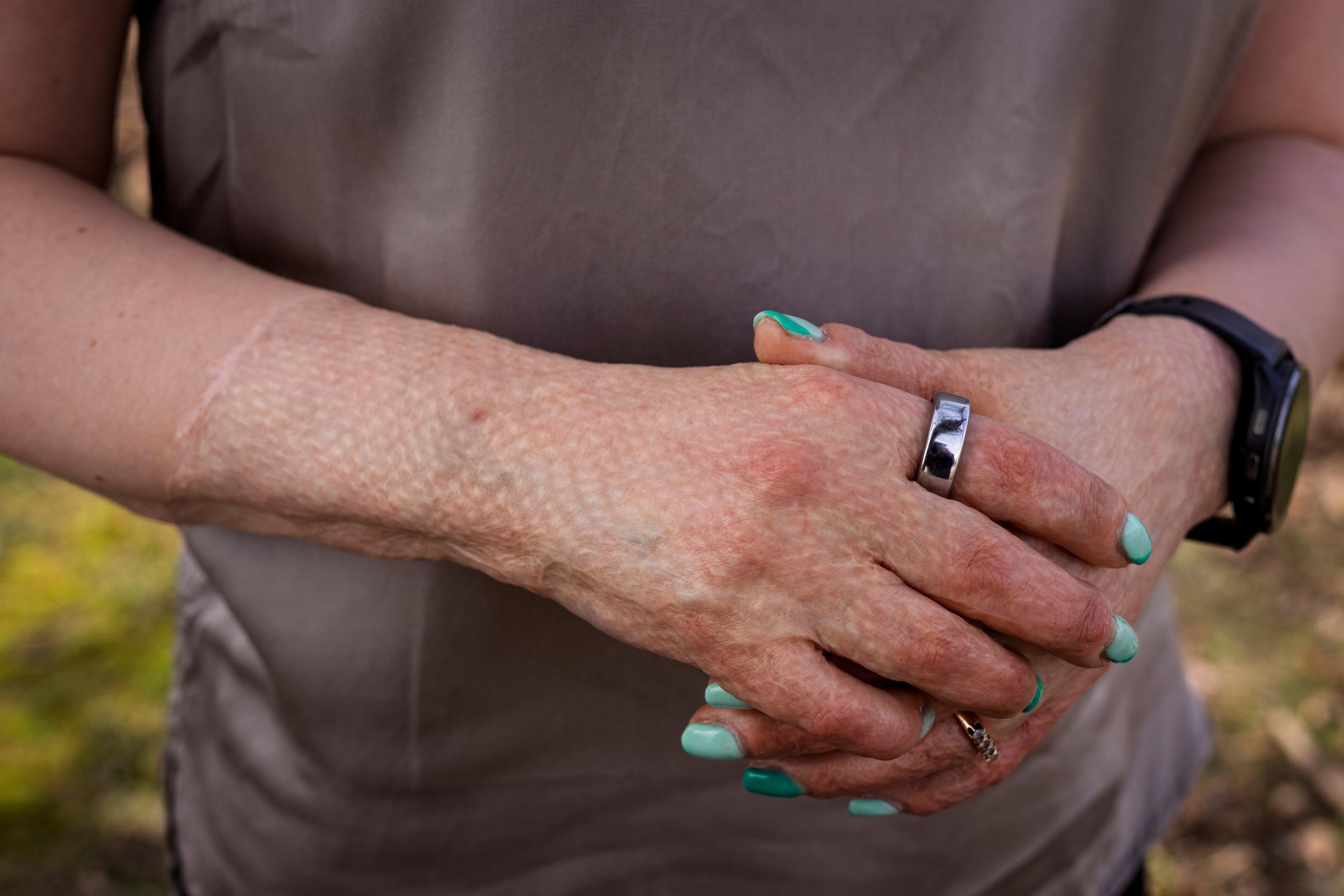 Ulrika loukkaantui ja paloi onnettomuudessa pahoin. Hän on joutunut käyttämään kaikki voimavaransa, kykynsä ja taitonsa, jotta hän pystyi rakentamaan itsensä uudelleen.