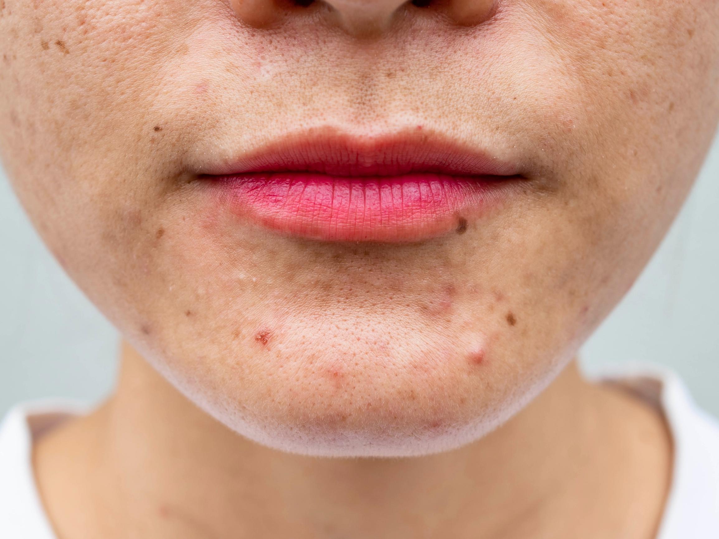 Nouseeko leukaasi kerran kuussa jomottava ihonalainen finni? Nämä 5 tuotetta voivat auttaa – yksi niistä pelastaa, kun tilanne on paha