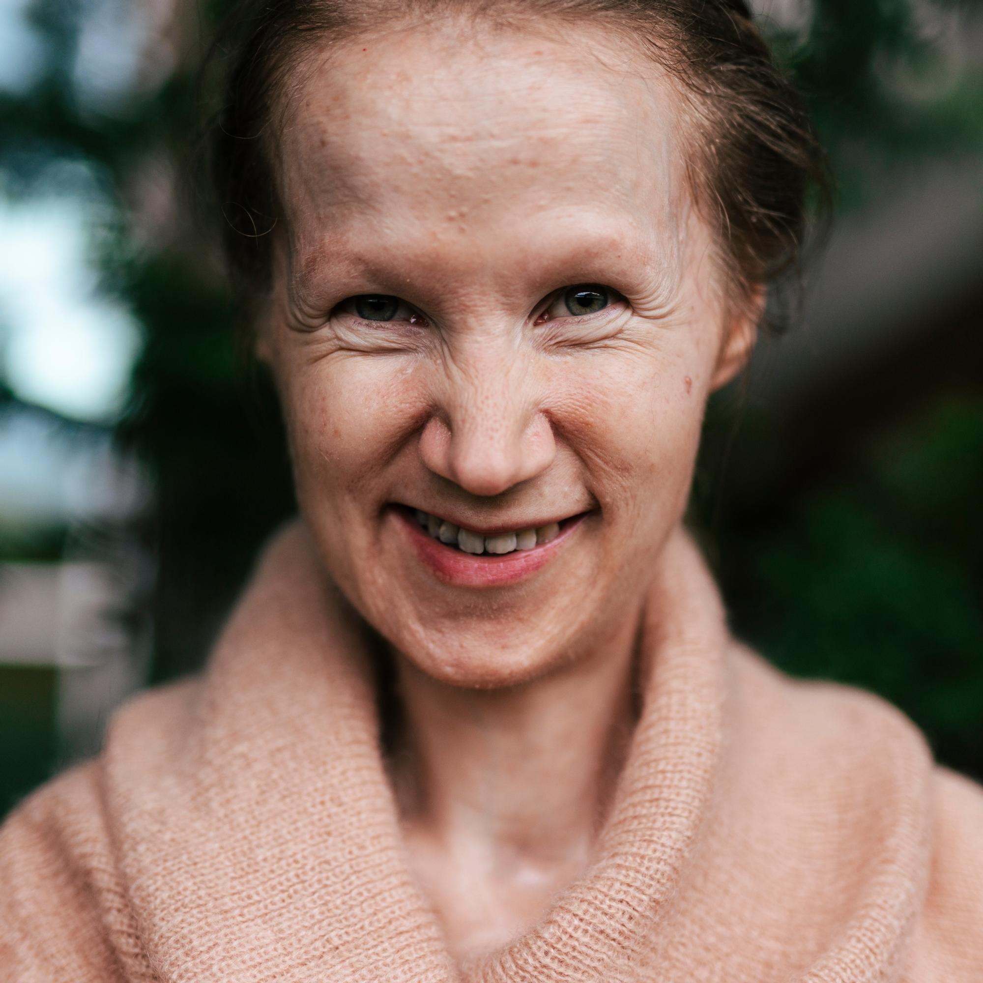 Jonnalla, 38, on sairaus, josta moni lääkärikään ei ole kuullut – suu avautuu enää vain 2 milliä eikä pää käänny