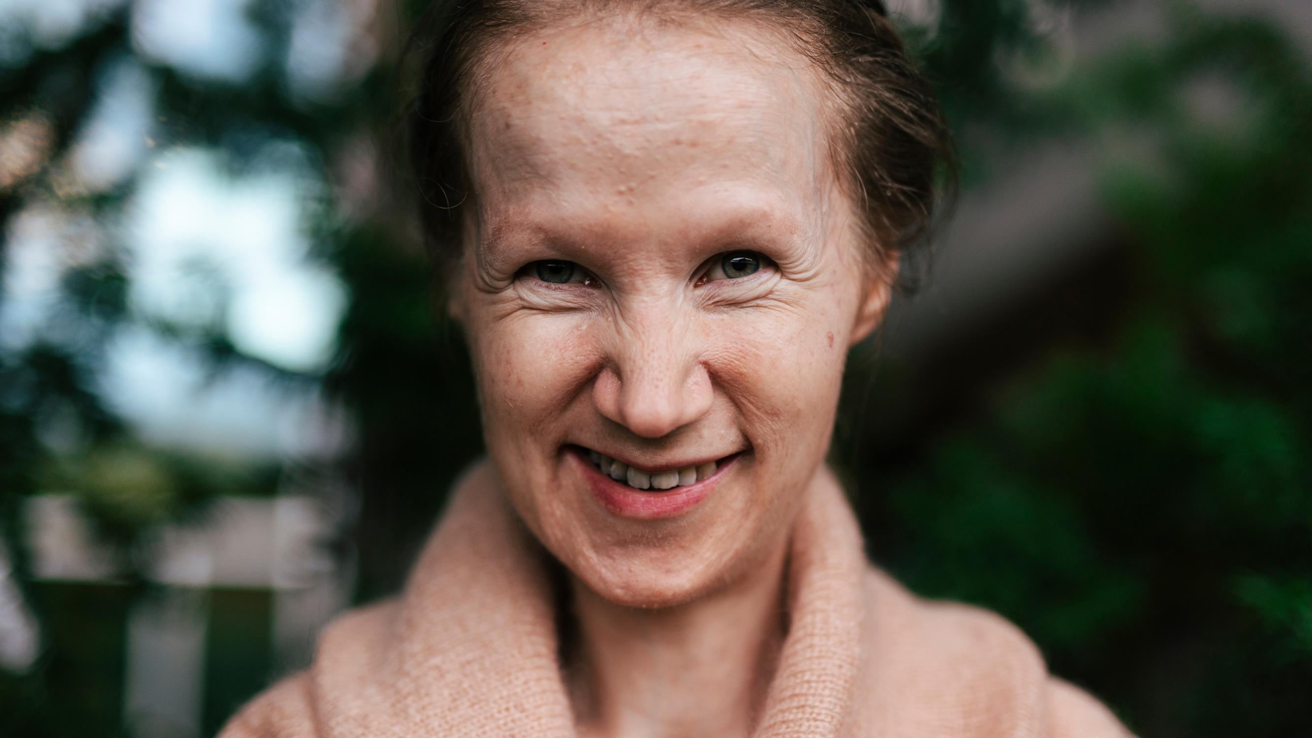 Jonnalla, 38, on sairaus, josta moni lääkärikään ei ole kuullut – suu avautuu enää vain 2 milliä eikä pää käänny