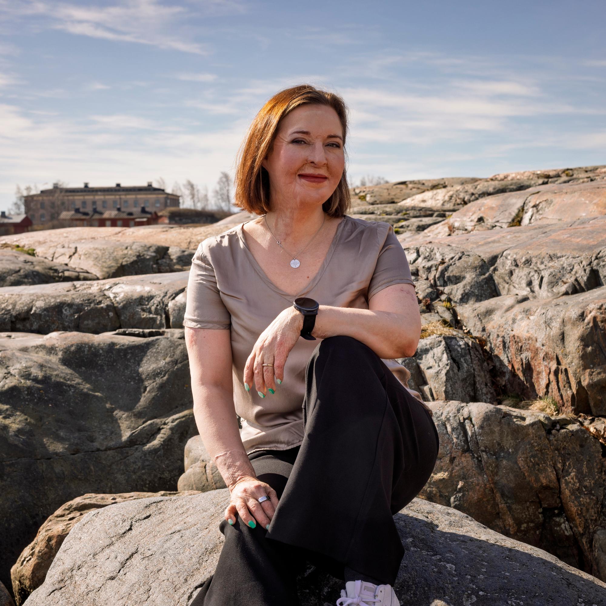 Kun Ulrikan kasvot ja kädet paloivat pahoin vakavassa onnettomuudessa, elämä meni uusiksi: ”Mikä olen, jos peilikuva ei ole minä?”