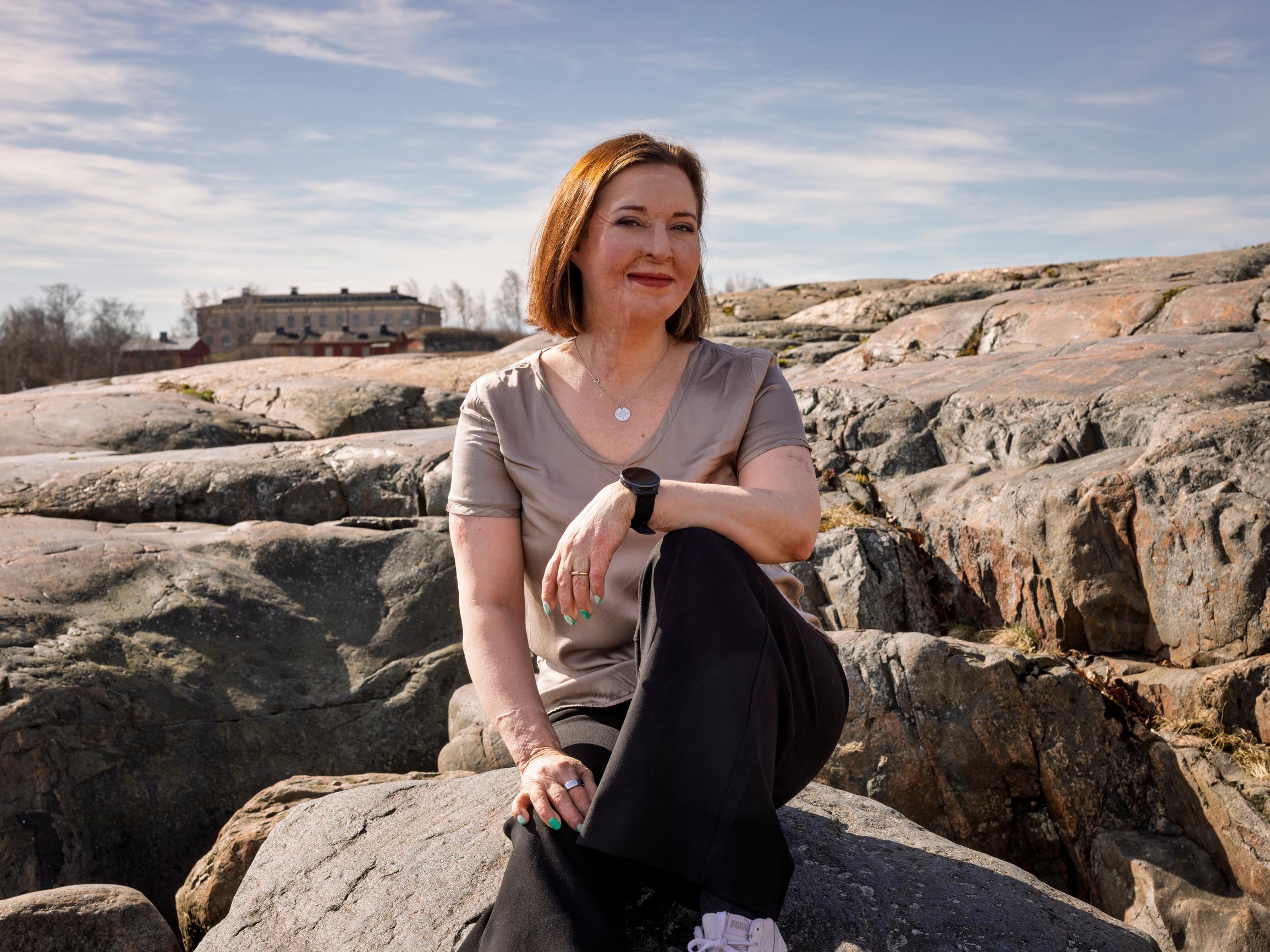 Kun Ulrikan kasvot ja kädet paloivat pahoin vakavassa onnettomuudessa, elämä meni uusiksi: ”Mikä olen, jos peilikuva ei ole minä?”