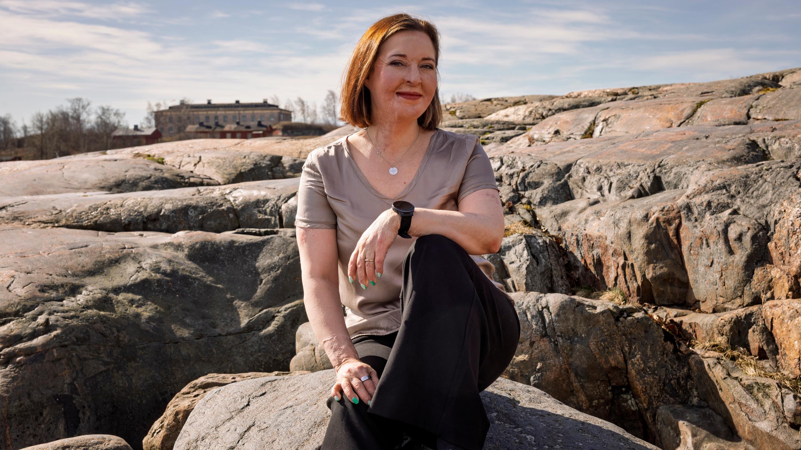 Kun Ulrikan kasvot ja kädet paloivat pahoin vakavassa onnettomuudessa, elämä meni uusiksi: ”Mikä olen, jos peilikuva ei ole minä?”