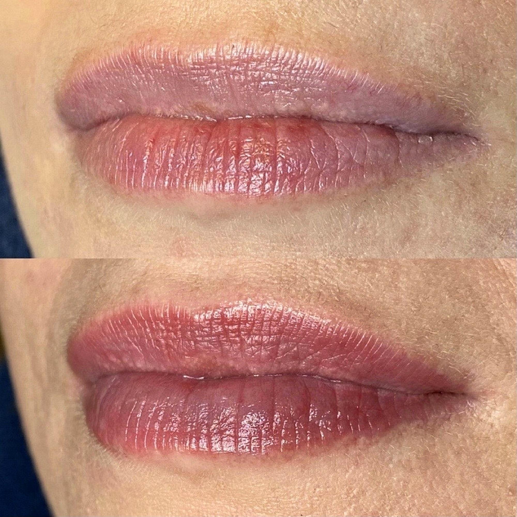 Huulet ennen käsittelyä ja sen jälkeen.