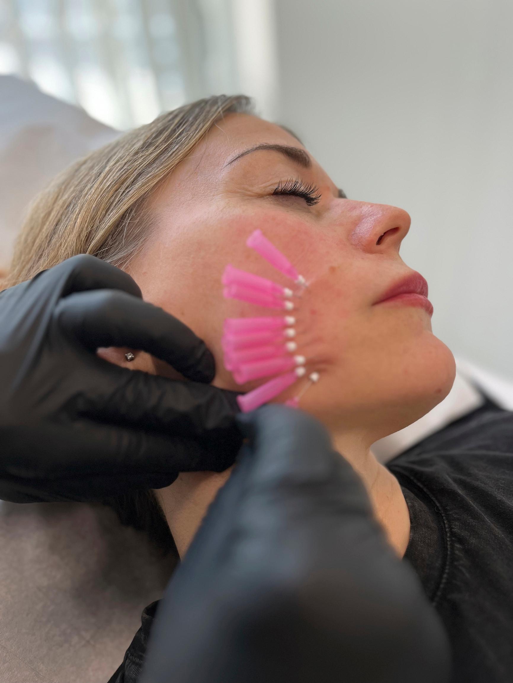 Kauneustoimittaja testasi mesolangat, happopistokset, mikroneulauksen ja tuhkimohoidon – näin ne toimivat