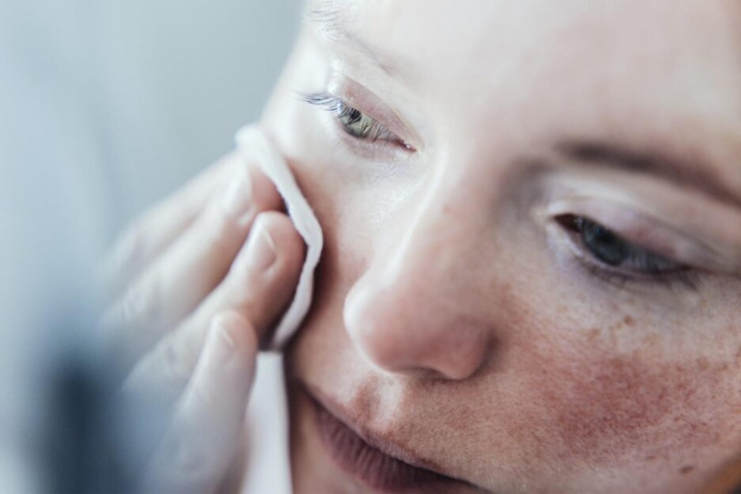 Ruusufinnin hoito voi olla lähes salapoliisityötä – kosmetologi kertoo, mikä on tärkeintä selvittää