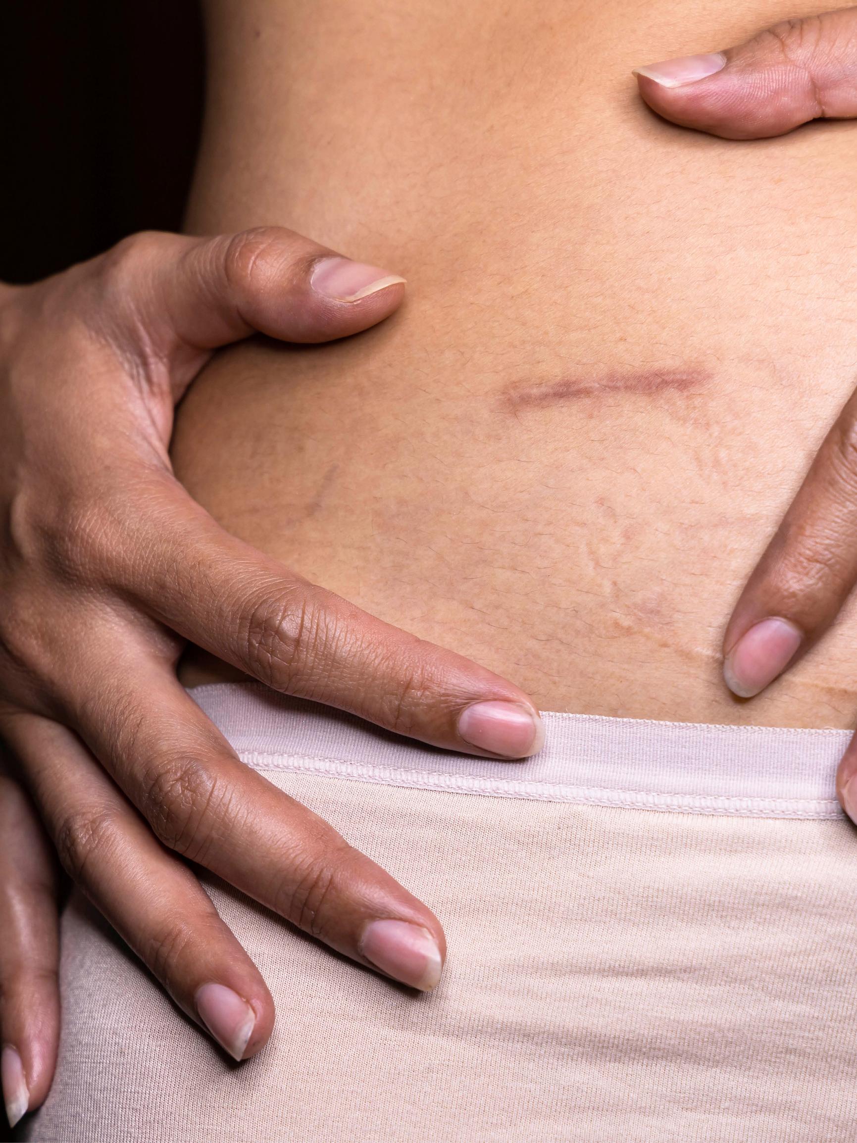 Tiesitkö, että arpia on kolmenlaisia? Plastiikkakirurgi kertoo, miten niitä voi häivyttää – ja milloin on syytä mennä lääkäriin