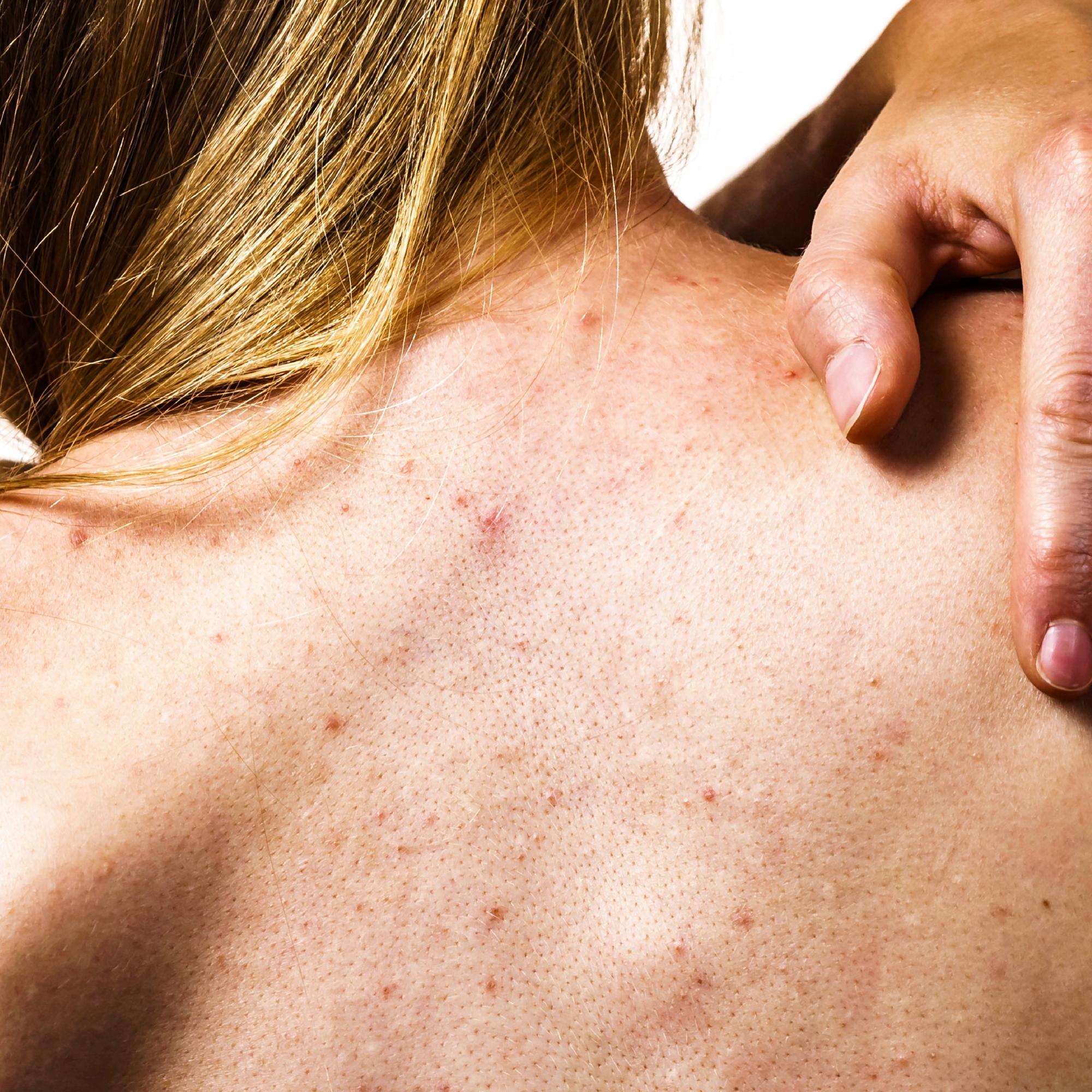 Tiesitkö, että hiustenpesu voi aiheuttaa finnejä selkään? Kosmetologi kertoo, miten taltuttaa epäpuhtaudet selässä