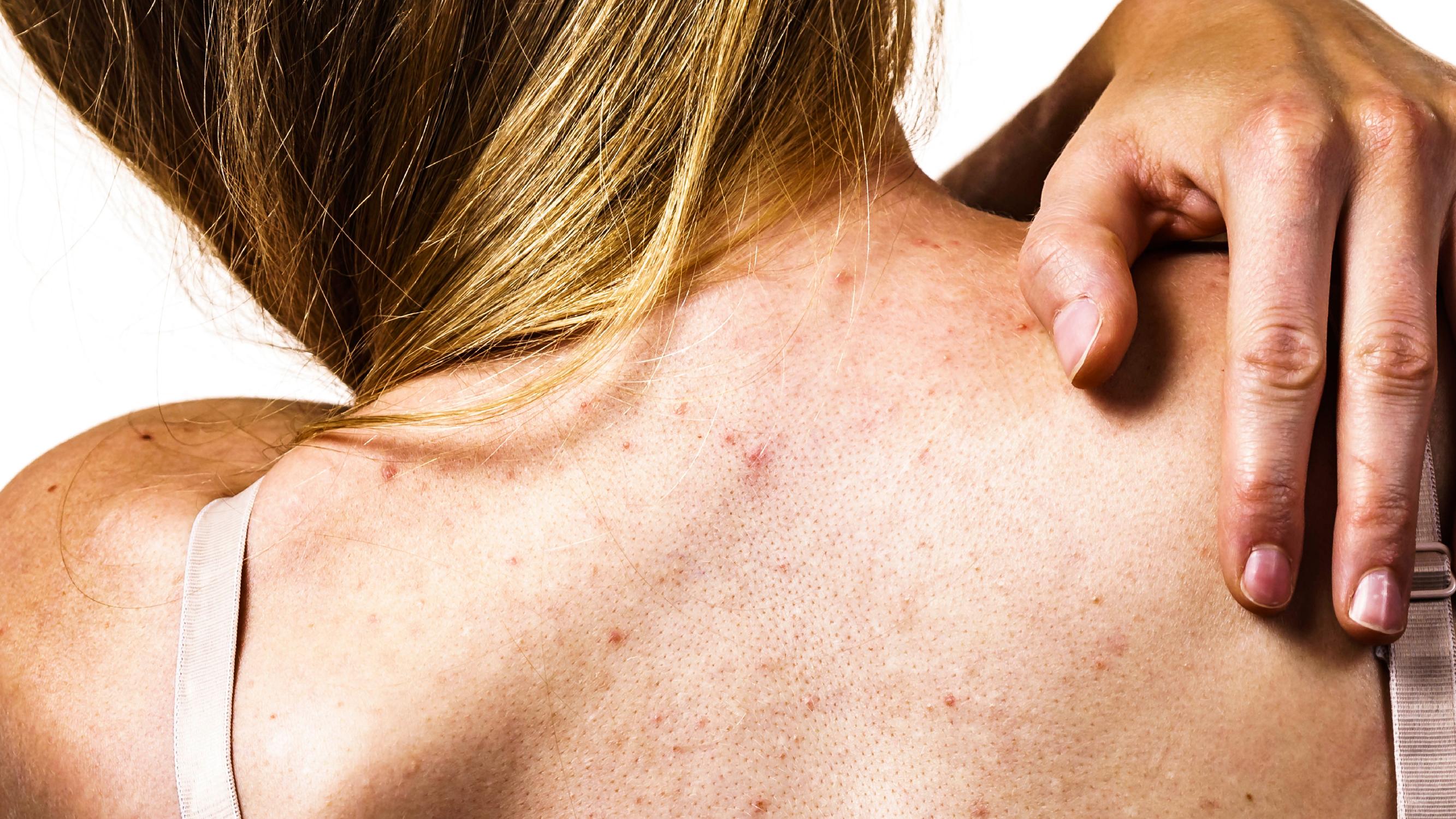 Tiesitkö, että hiustenpesu voi aiheuttaa finnejä selkään? Kosmetologi kertoo, miten taltuttaa epäpuhtaudet selässä