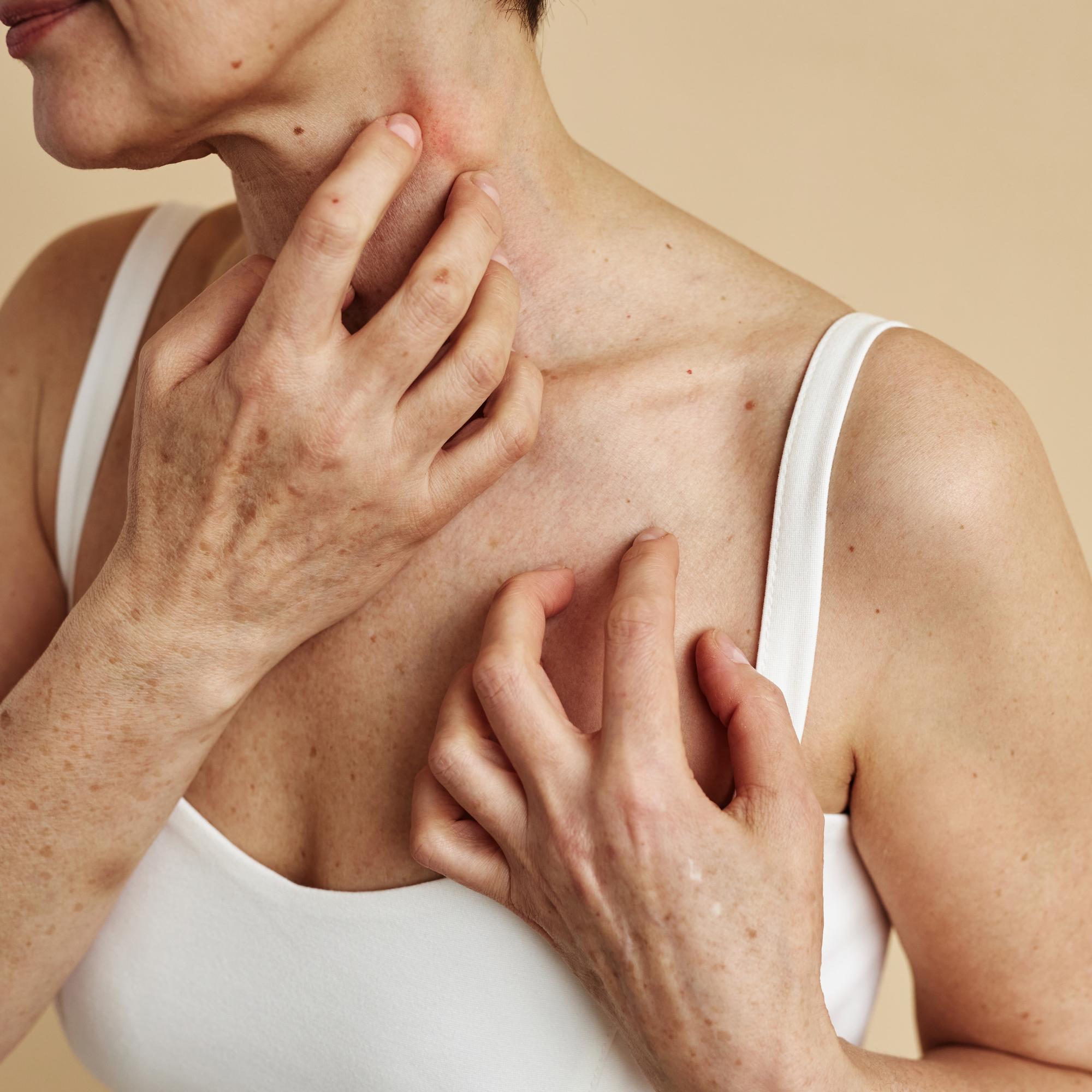 Saitko oireita kosmetiikasta? Yhtä asiaa ei saa missään nimessä tehdä, jos iho ärsyyntyy