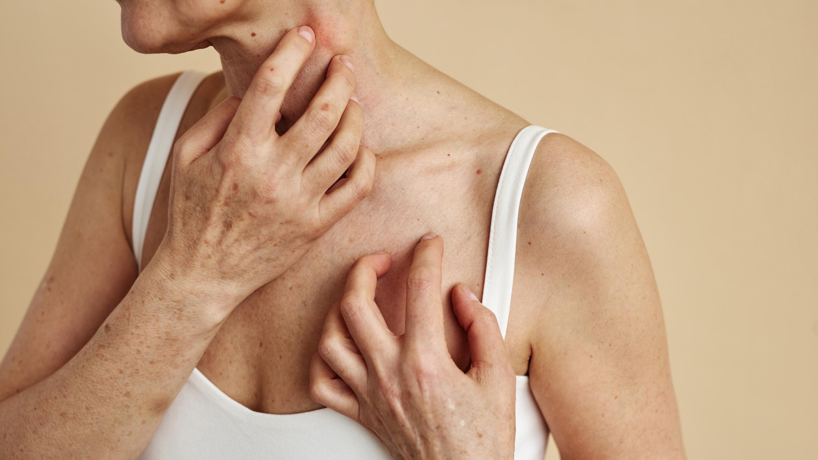 Saitko oireita kosmetiikasta? Yhtä asiaa ei saa missään nimessä tehdä, jos iho ärsyyntyy