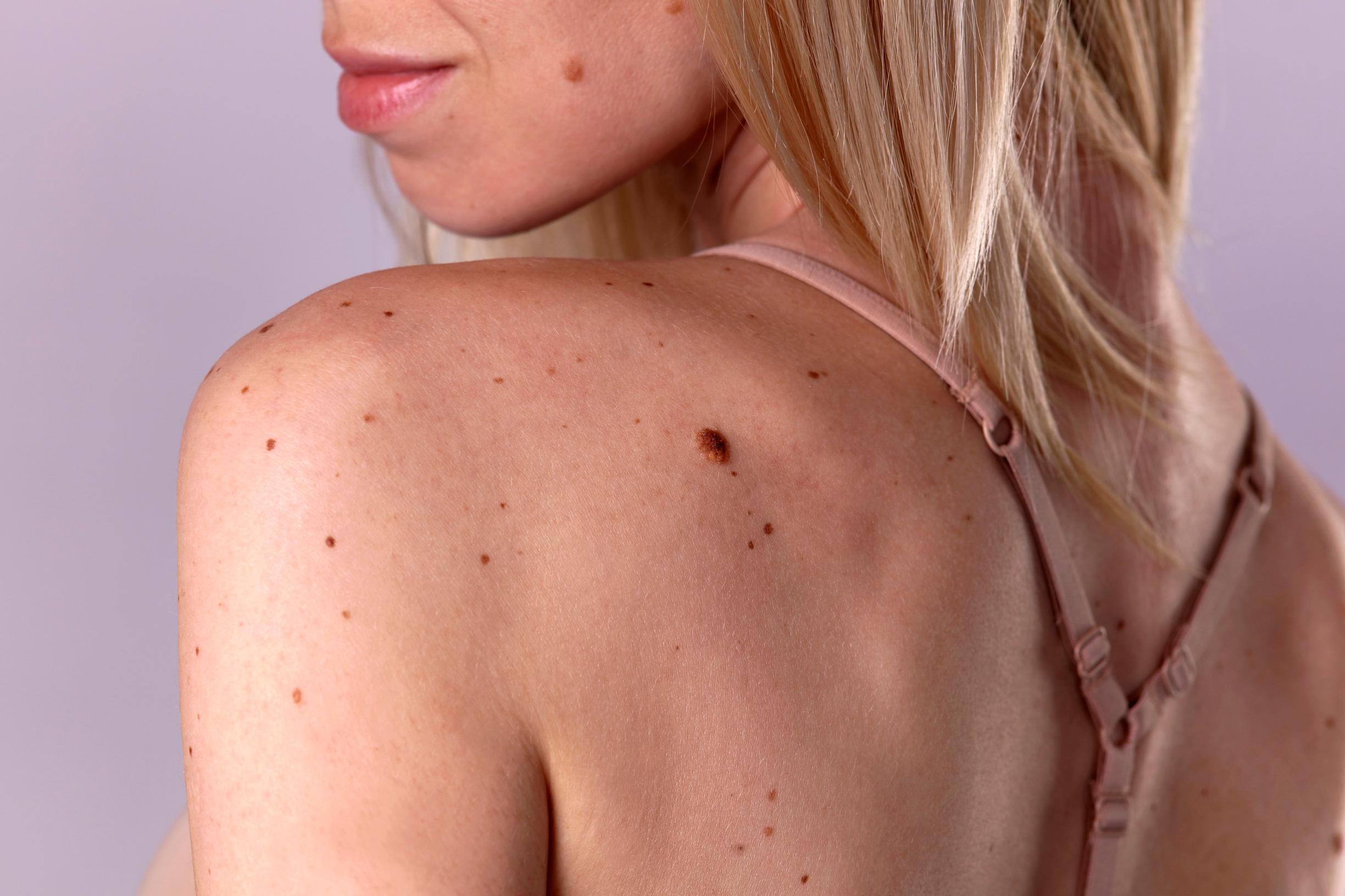 Näin erotat vaaralliset luomet vaarattomista