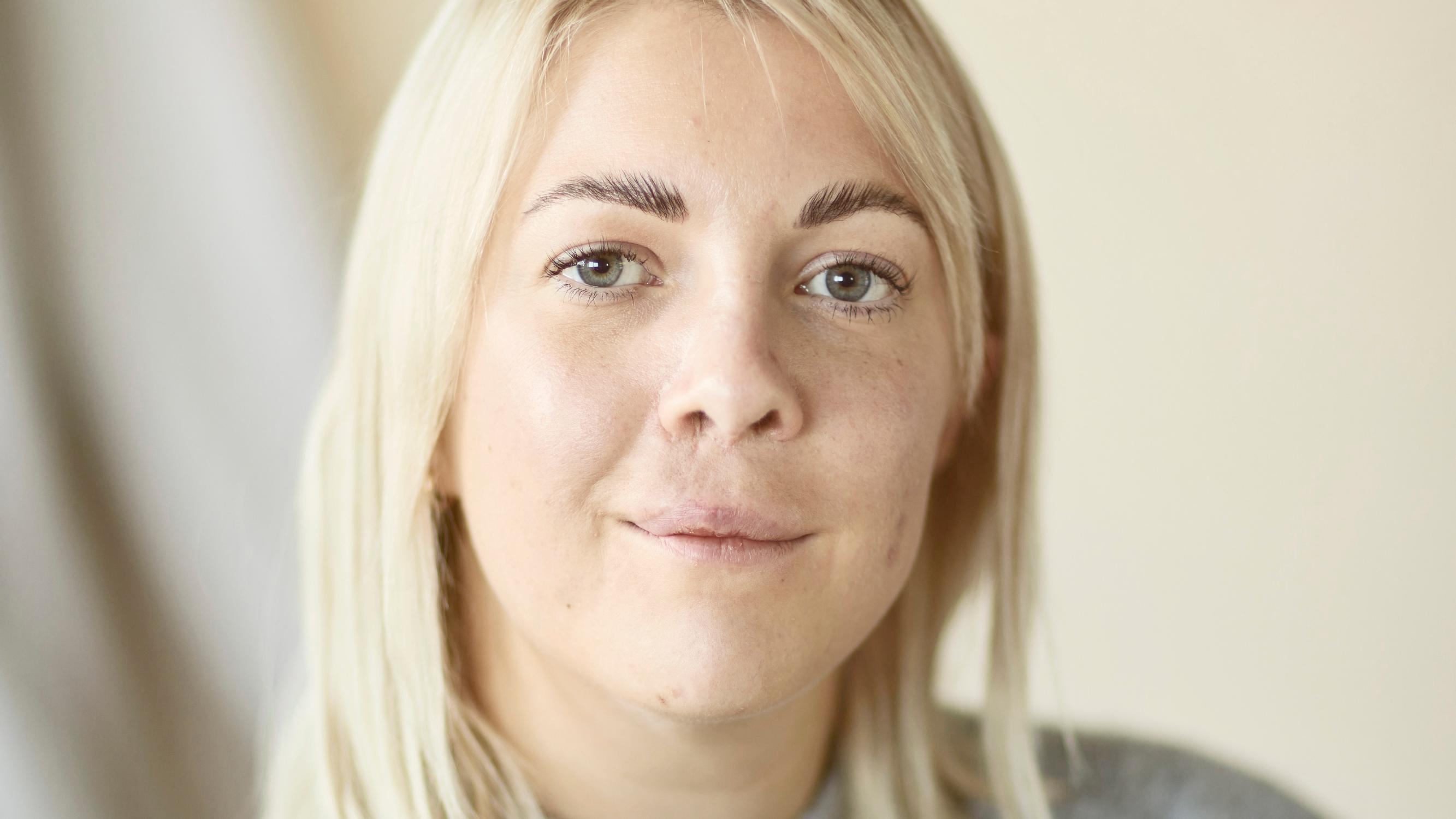 ”Teini-ikäisenä huusin vanhemmilleni, että synnytitte ruman lapsen” – suuren leikkauksen jälkeen Johanna tiesi, mitä haluaa tehdä työkseen